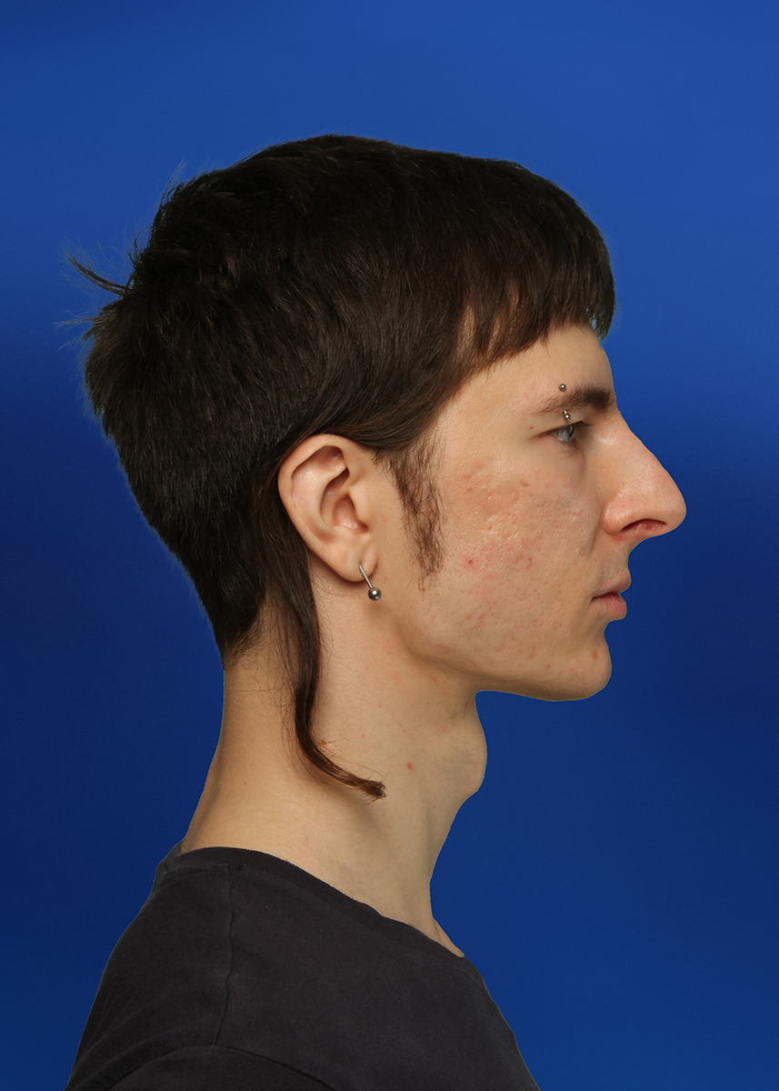 After Rhinoplasty - Front View